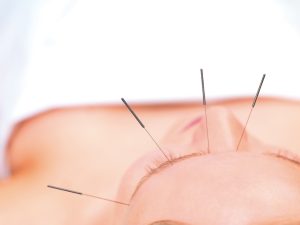Frente al dolor, mejora tus cefaleas con acupuntura