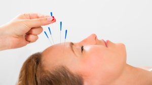 Frente al dolor, mejorar tus cefaleas con acupuntura, ¡es posible!